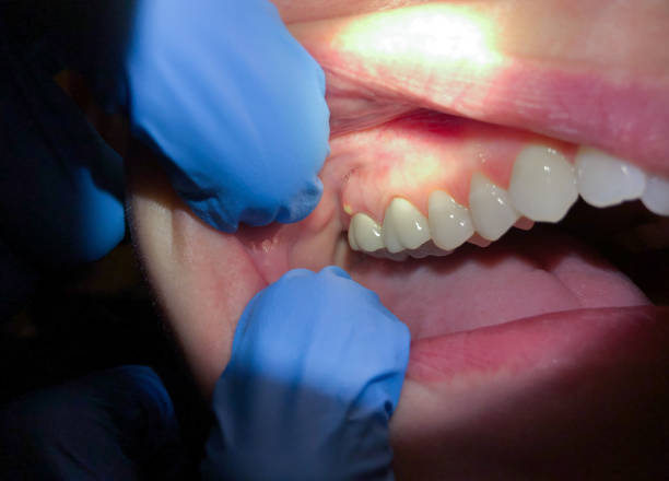 Best Emergency Wisdom Teeth Removal in Mill City, OR