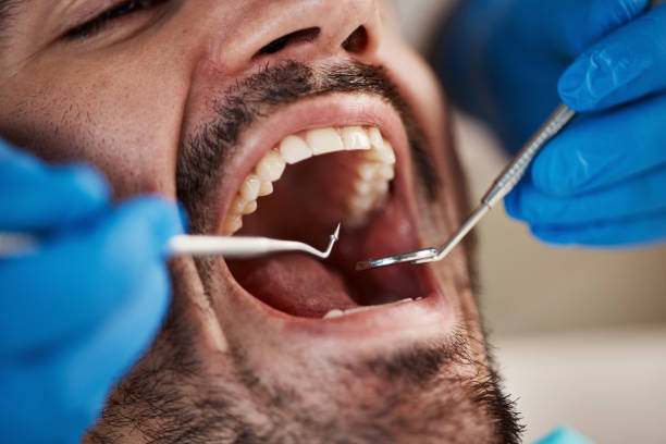 Best Emergency Wisdom Teeth Removal in Mill City, OR